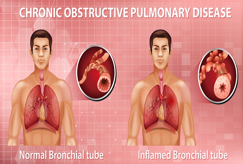 Chronic Obstructive Pulmonary Disease (COPD): What You Need to Know